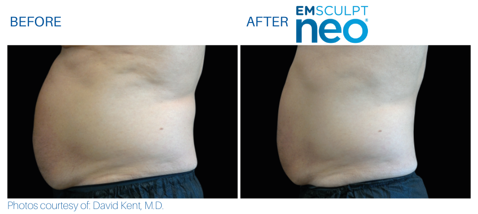 Man's abdomen showing less fat and more muscle Before and After Emsculpt NEO treatment