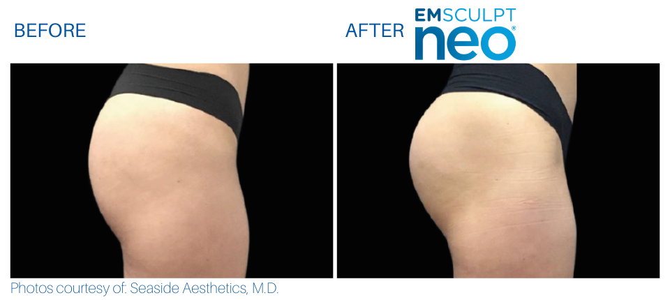 Woman's buttocks showing more muscle and less fat Before and After Emsculpt NEO treatment