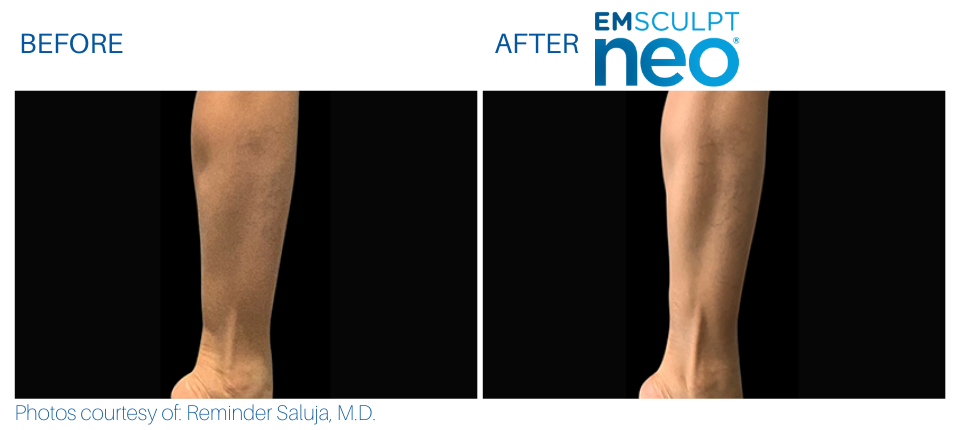 Woman's calf showing more sculpted and toned muscles Before and After Emsculpt NEO treatment