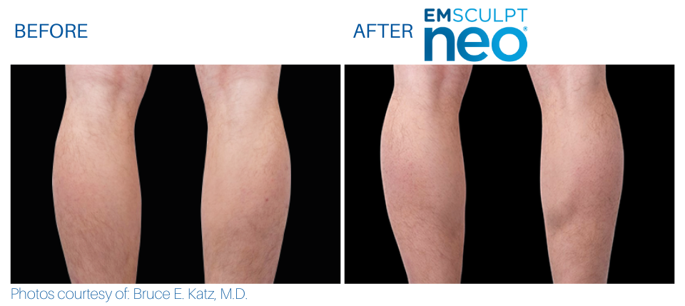 Woman's calves showing more sculpted and toned muscles Before and After Emsculpt NEO treatment