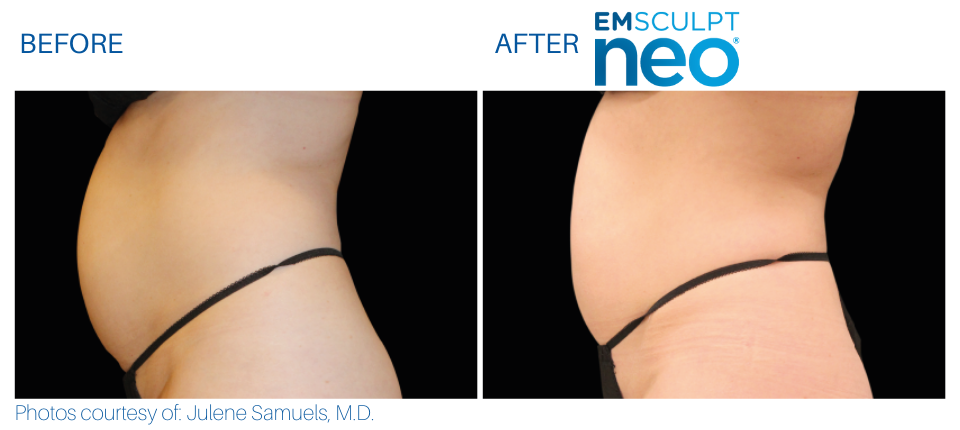 Woman's abdomen showing less fat and more muscle Before and After Emsculpt NEO