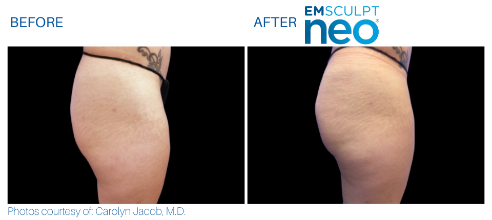 Woman's buttocks showing more muscle and less fat Before and After Emsculpt NEO treatment