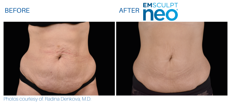 Woman's abdomen showing less fat and more toned and sculpted muscles Before and After Emsculpt NEO treatment