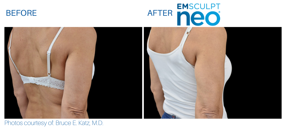 Woman's back and arm showing less fat and more sculpted and toned muscles Before and After Emsculpt NEO treatment