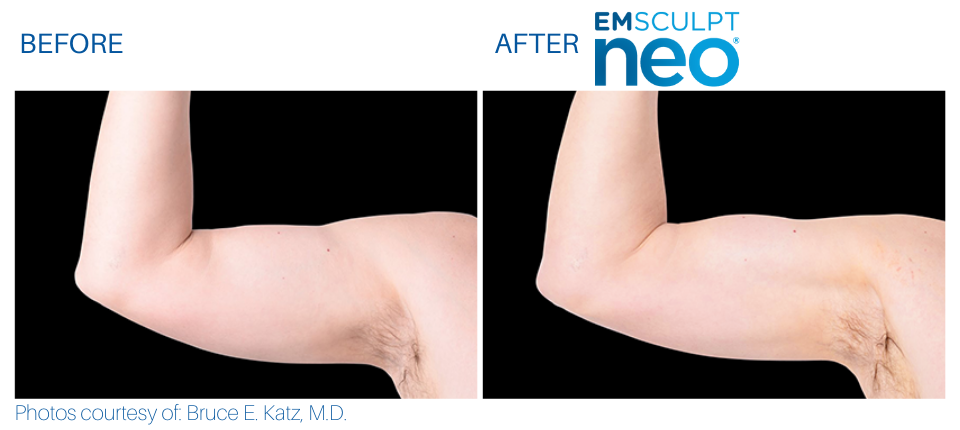 Man's upper arm showing more sculpted and toned muscles Before and After Emsculpt NEO treatment