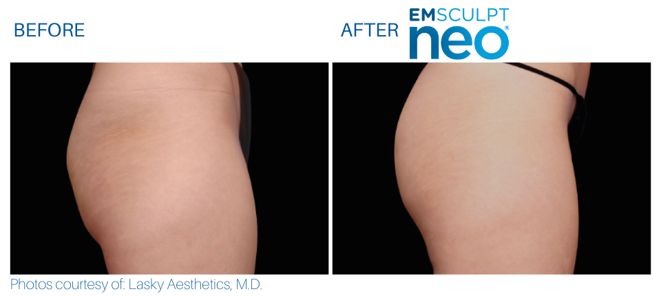 Woman's buttocks showing more muscle and less fat Before and After Emsculpt NEO treatment