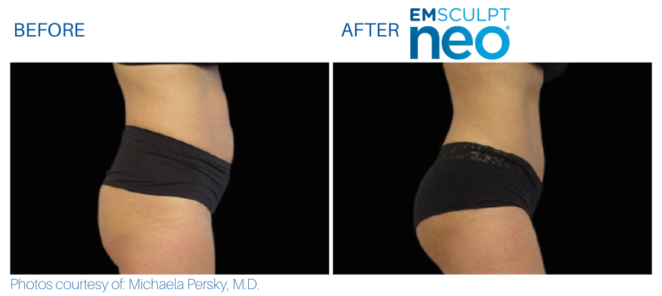 Woman's abdomen showing more muscle and less fat Before and After Emsculpt NEO