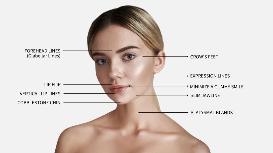 Graphic with beautiful woman with perfect skin showing the different treatment areas for Botox