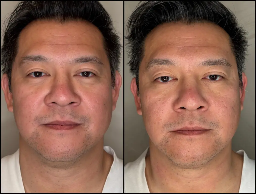 XERF to improve skin laxity, tighten skin with RF in Diamond Bar, CA