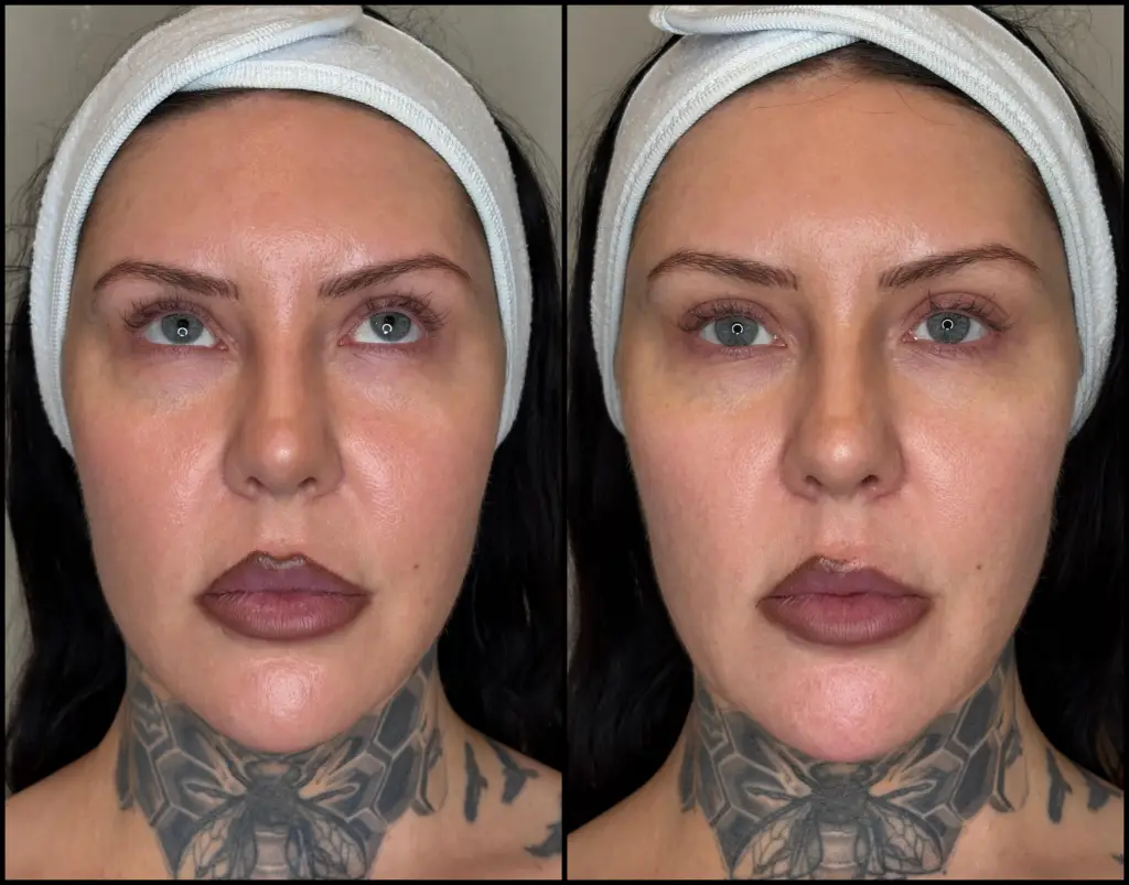 XERF treatment improves nasolabial folds in Diamond Bar, CA